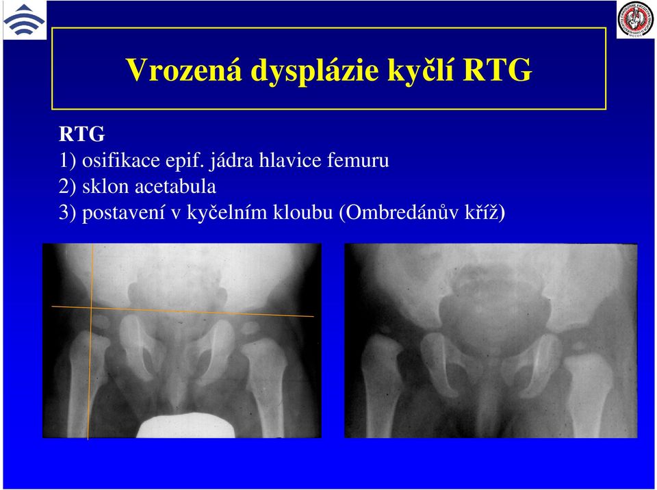 jádra hlavice femuru 2) sklon