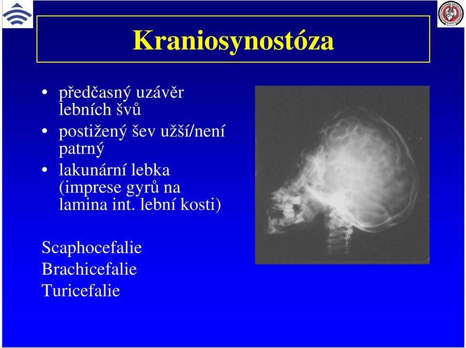 lakunární lebka (imprese gyrů na lamina int.