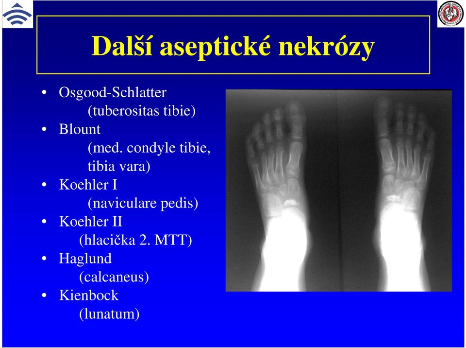 condyle tibie, tibia vara) Koehler I (naviculare