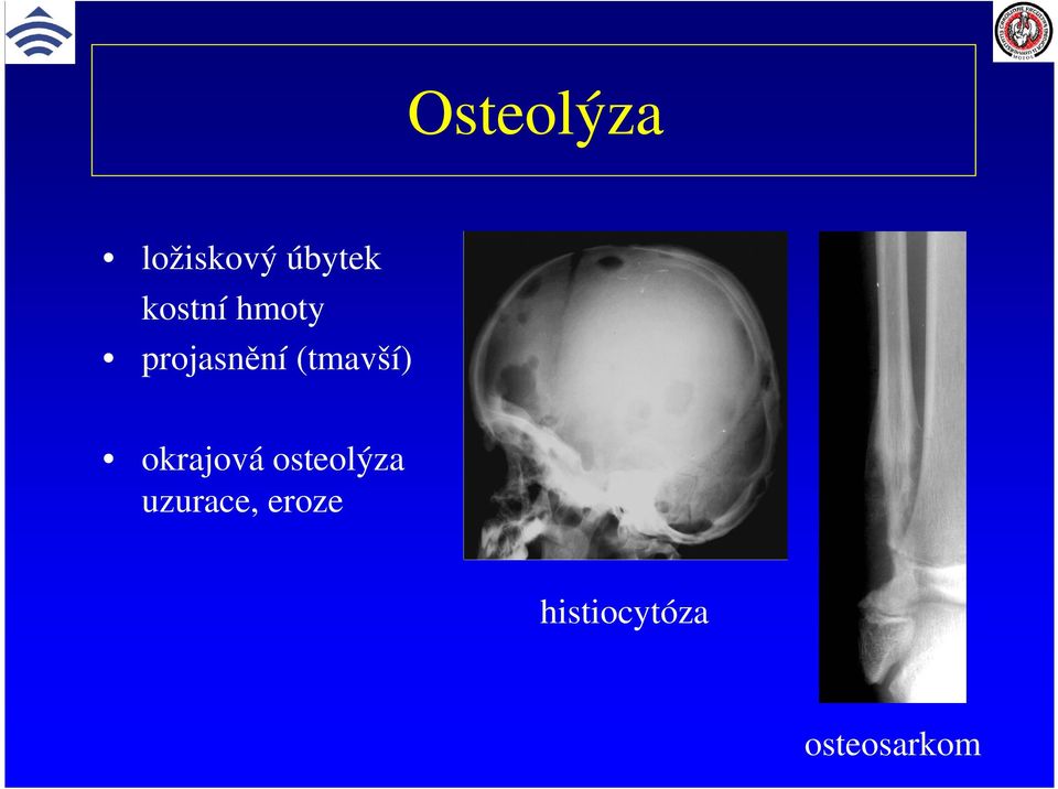 (tmavší) okrajová osteolýza
