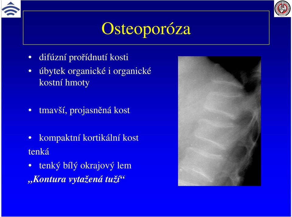 projasněná kost kompaktní kortikální kost