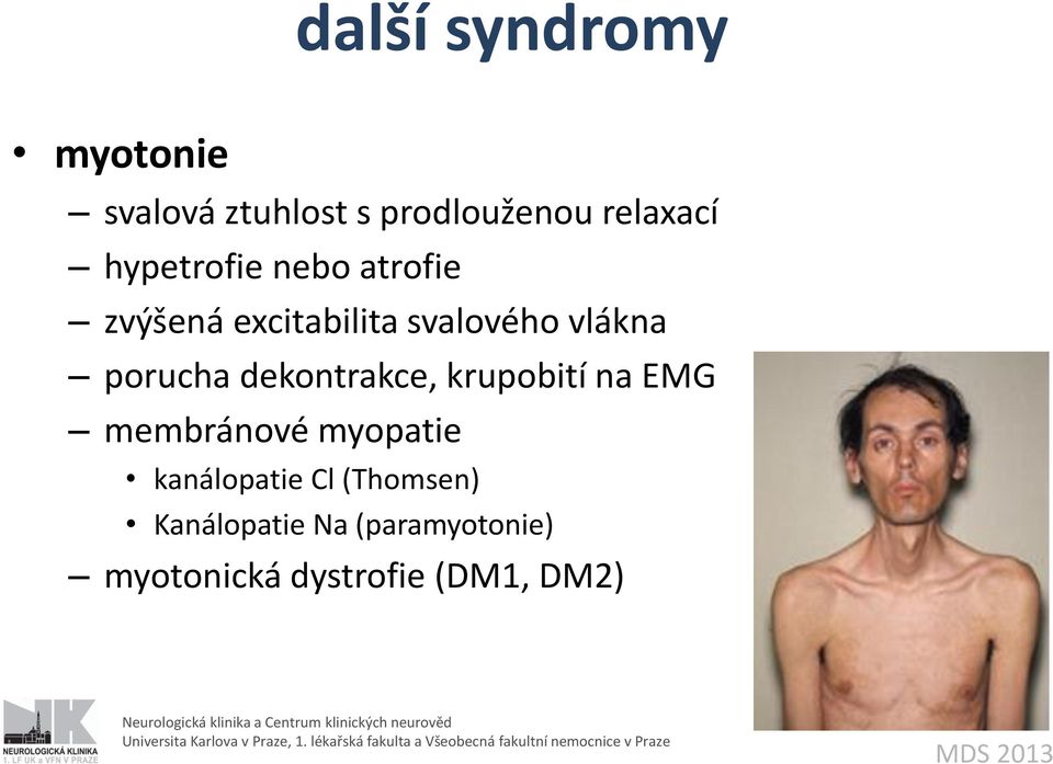 dekontrakce, krupobití na EMG membránové myopatie kanálopatie Cl