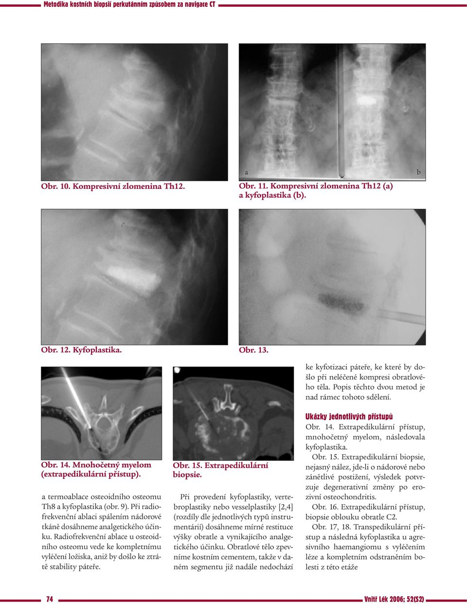 Radiofrekvenční ablace u osteoidního osteomu vede ke kompletnímu vyléčení ložiska, aniž by došlo ke ztrátě stability páteře. Obr. 15. Extrapedikulární biopsie.
