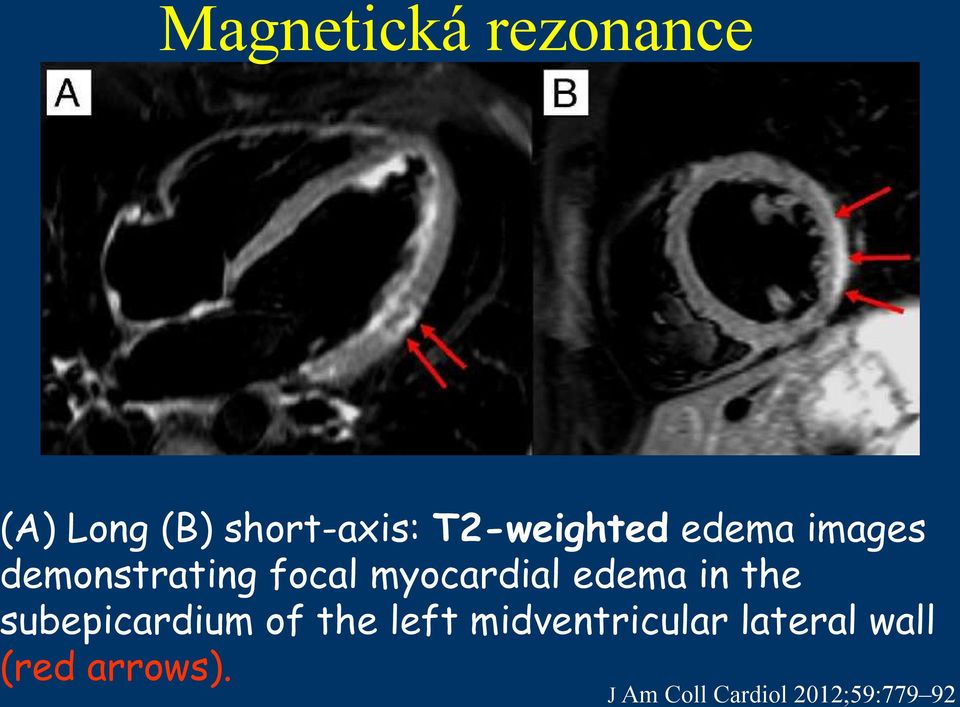 myocardial edema in the subepicardium of the left
