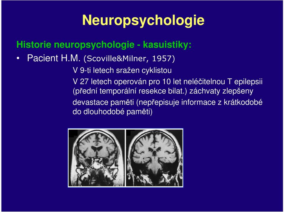 pro 10 let neléčitelnou T epilepsii (přední temporální resekce bilat.