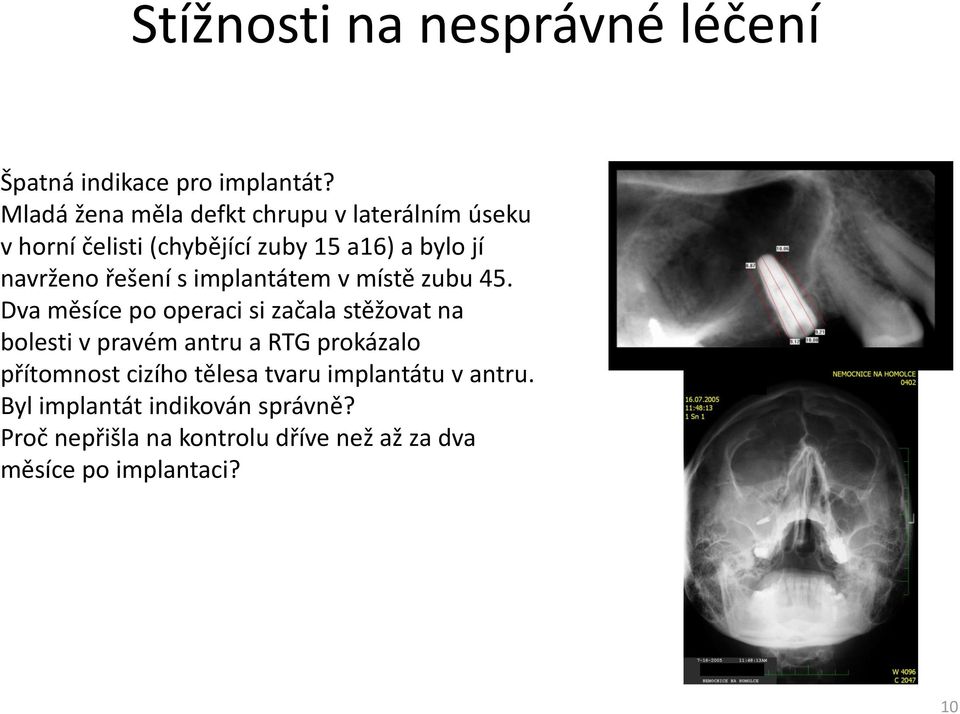 řešení s implantátem v místě zubu 45.