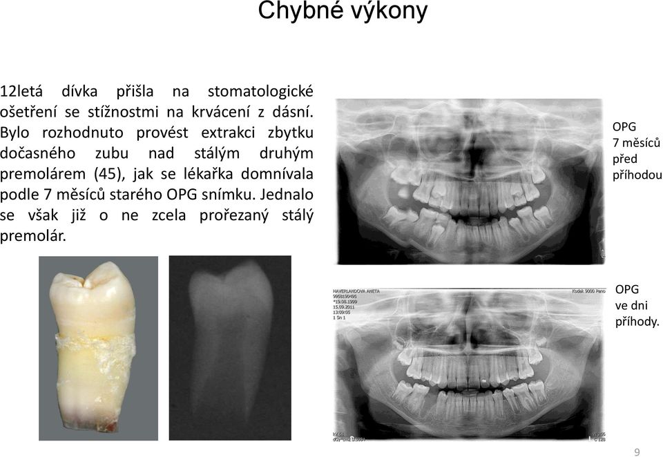 Bylo rozhodnuto provést extrakci zbytku dočasného zubu nad stálým druhým premolárem