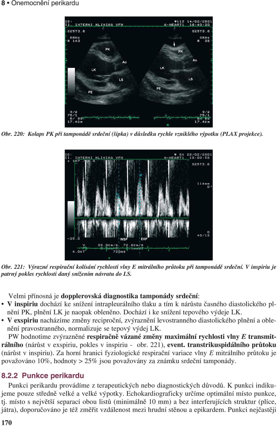 Velmi přínosná je dopplerovská diagnostika tamponády srdeční: Vinspiriu dochází ke snížení intrapleurálního tlaku a tím k nárůstu časného diastolického plnění PK, plnění LK je naopak obleněno.