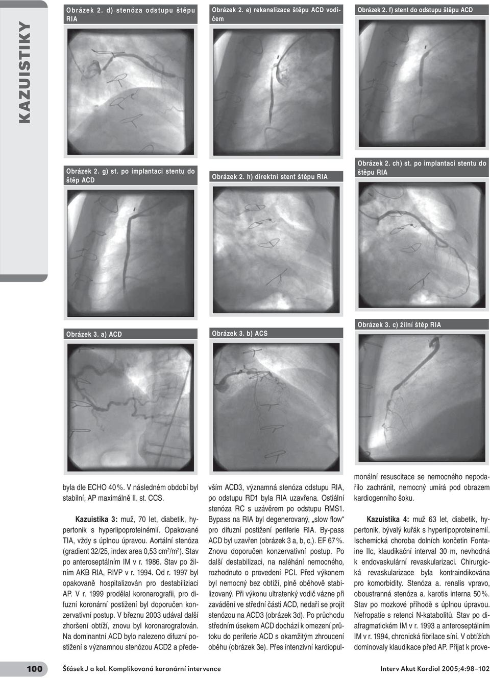 V následném období byl stabilní, AP maximálně II. st. CCS. Kazuistika 3: muž, 70 let, diabetik, hypertonik s hyperlipoproteinémií. Opakované TIA, vždy s úplnou úpravou.