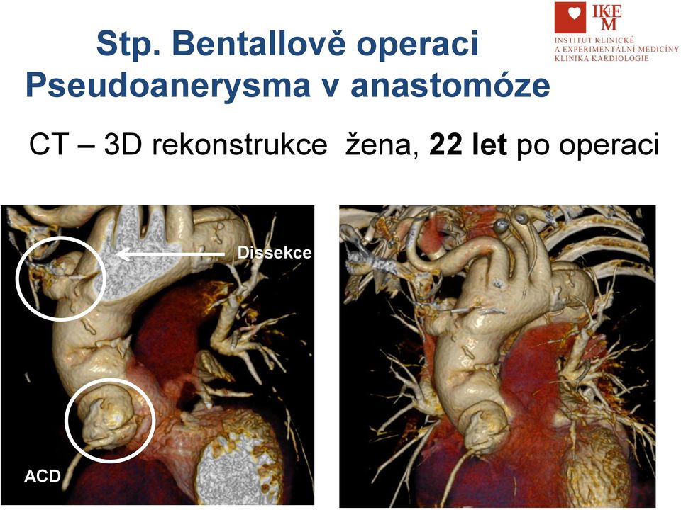 anastomóze CT 3D