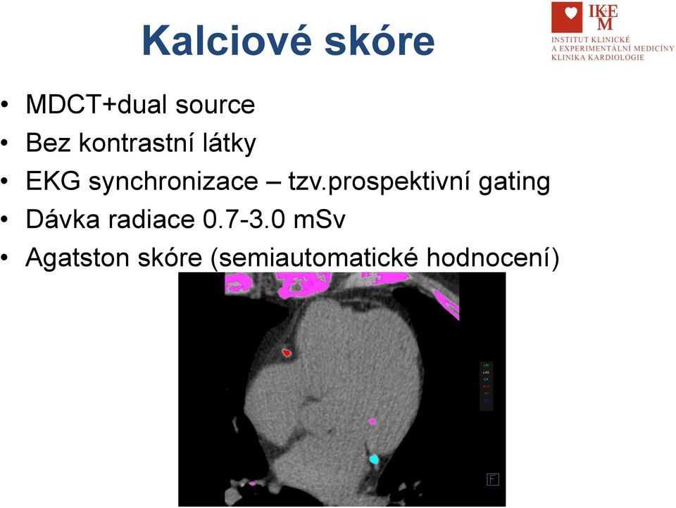 prospektivní gating Dávka radiace 0.7-3.