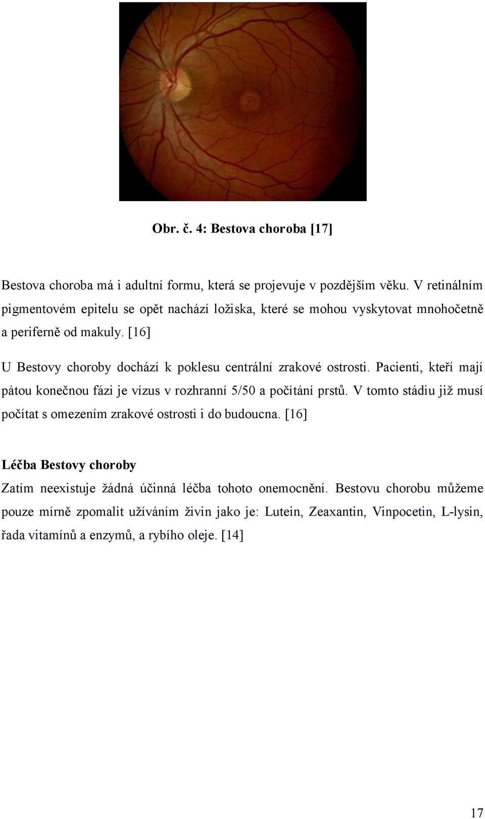 [16] U Bestovy choroby dochází k poklesu centrální zrakové ostrosti. Pacienti, kteří mají pátou konečnou fázi je vízus v rozhranní 5/50 a počítání prstů.