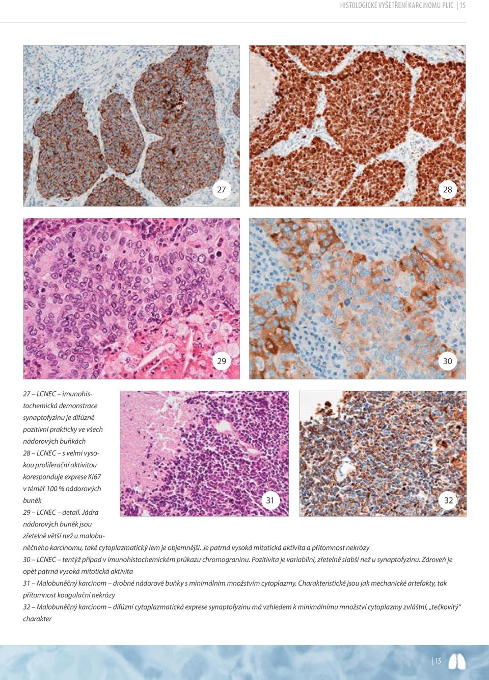 Jádra nádorových buněk jsou zřetelně větší než u malobuněčného 31 32 karcinomu, také cytoplazmatický lem je objemnější.