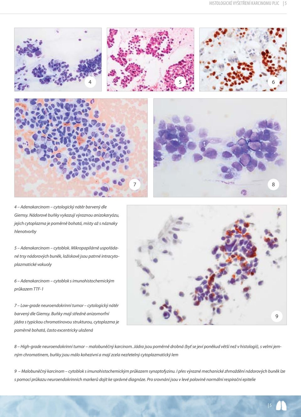 Mikropapilárně uspořádané trsy nádorových buněk, ložiskově jsou patrné intracytoplazmatické vakuoly 6 Adenokarcinom cytoblok s imunohistochemickým průkazem TTF-1 7 Low-grade neuroendokrinní tumor