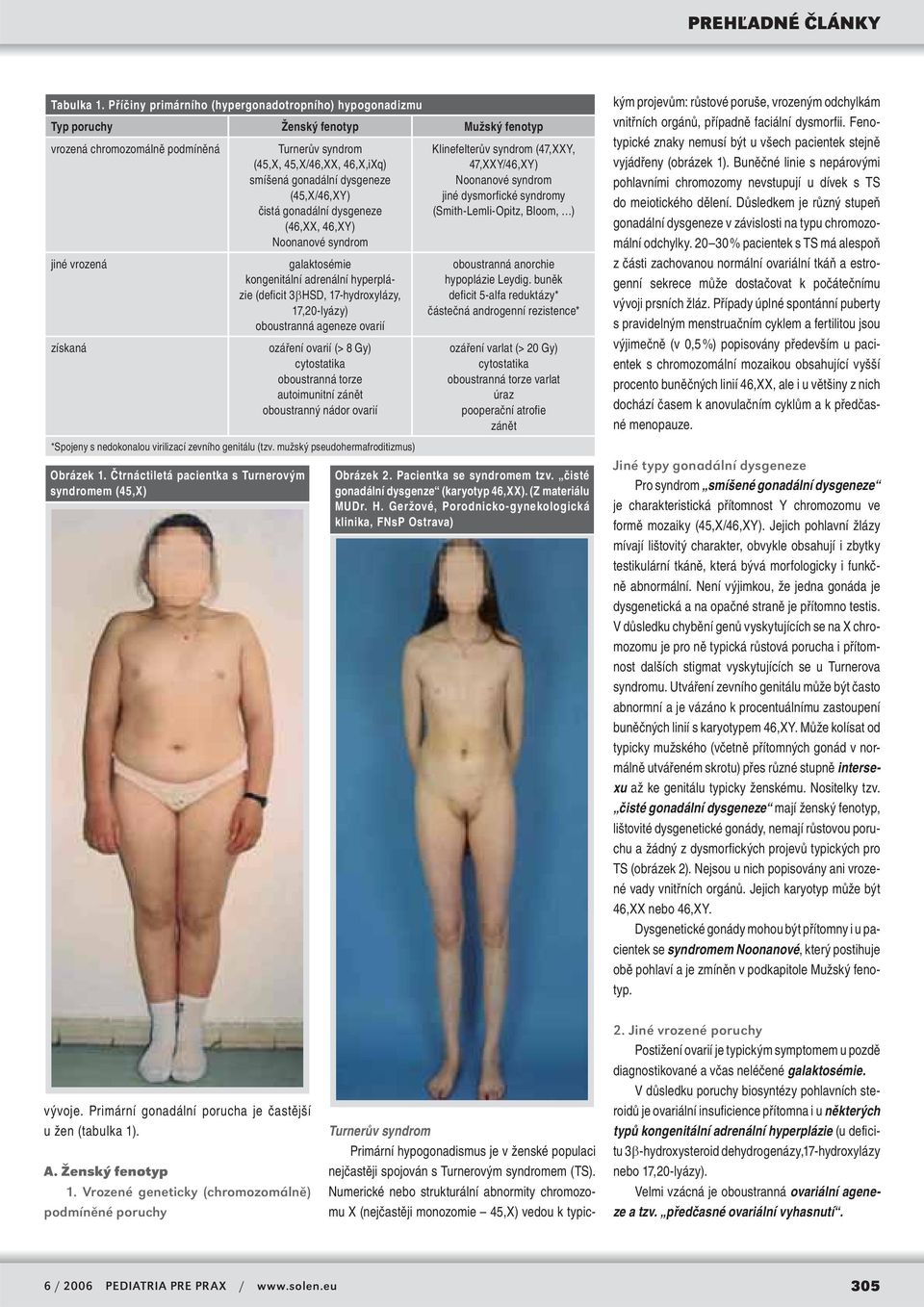 dysgeneze (45,X/46,XY) čistá gonadální dysgeneze (46,XX, 46,XY) Noonanové syndrom Klinefelterův syndrom (47,XXY, 47,XXY/46,XY) Noonanové syndrom jiné dysmorfické syndromy (Smith-Lemli-Opitz, Bloom, )