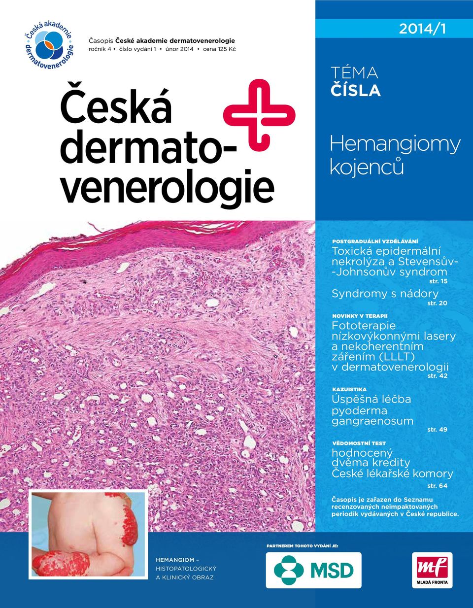 20 NOVINKY V TERAPII Fototerapie nízkovýkonnými lasery a nekoherentním zářením (LLLT) v dermatovenerologii str. 42 KAZUISTIKA Úspěšná léčba pyoderma gangraenosum str.