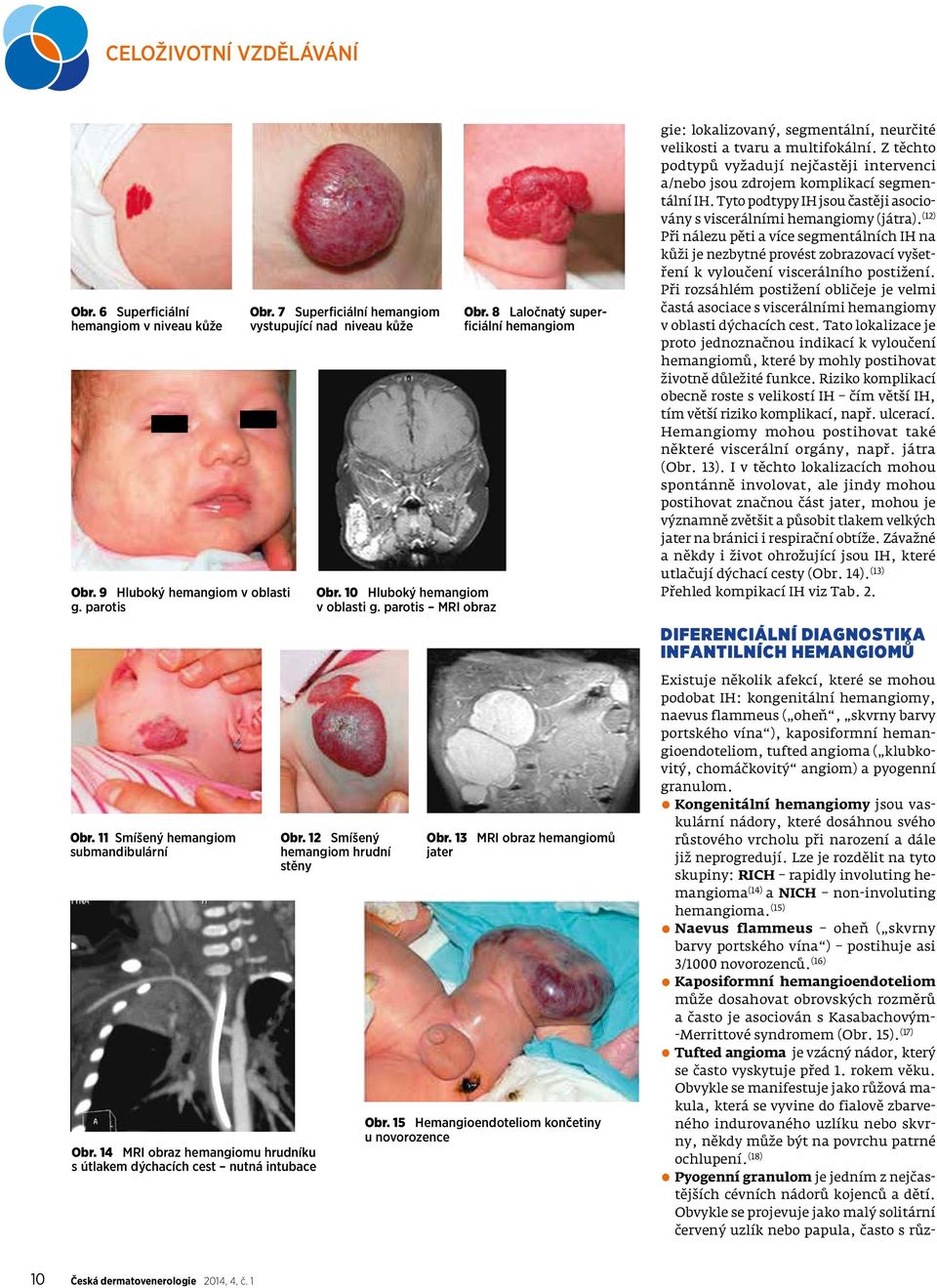 12 Smíšený hemangiom hrudní stěny Obr. 8 Laločnatý superficiální hemangiom Obr. 13 MRI obraz hemangiomů jater Obr.