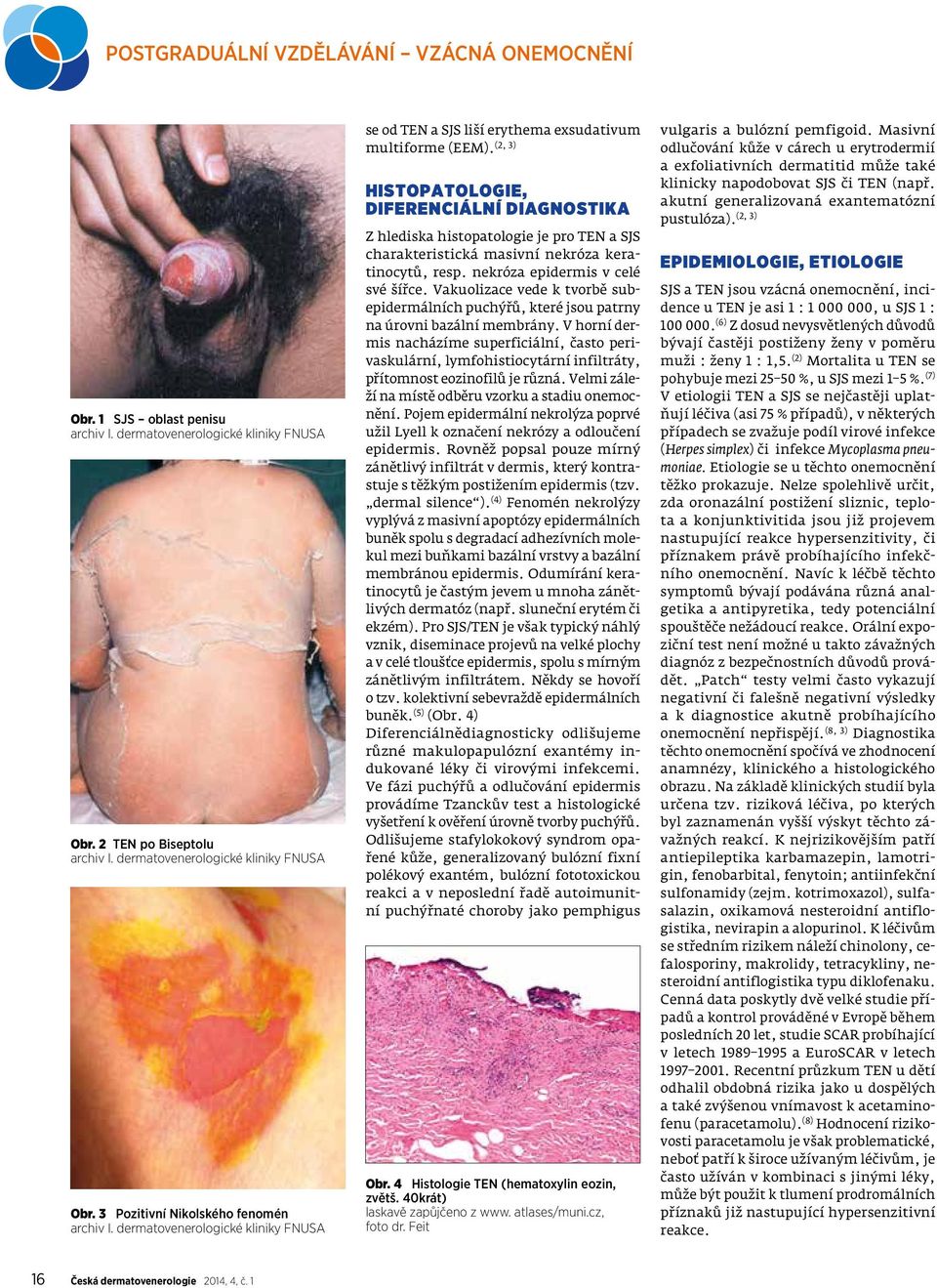 HISTOPATOLOGIE, DIFERENCIÁLNÍ DIAGNOSTIKA Z hlediska histopatologie je pro TEN a SJS charakteristická masivní nekróza keratinocytů, resp. nekróza epidermis v celé své šířce.