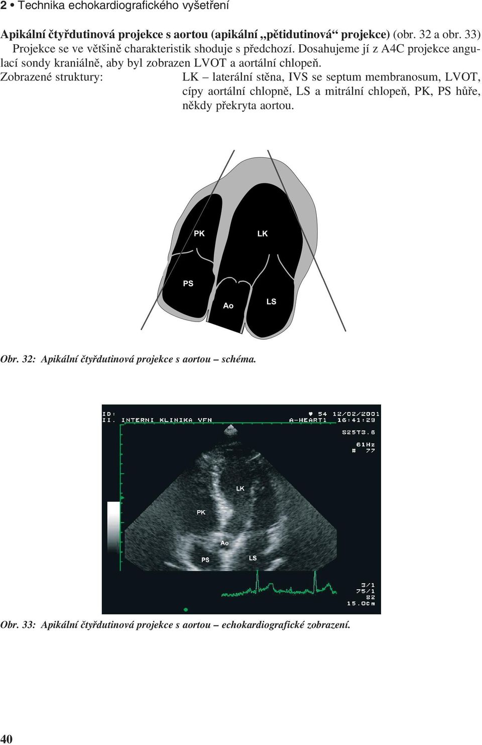 Dosahujeme jí z A4C projekce angulací sondy kraniálně, aby byl zobrazen LVOT a aortální chlopeň.