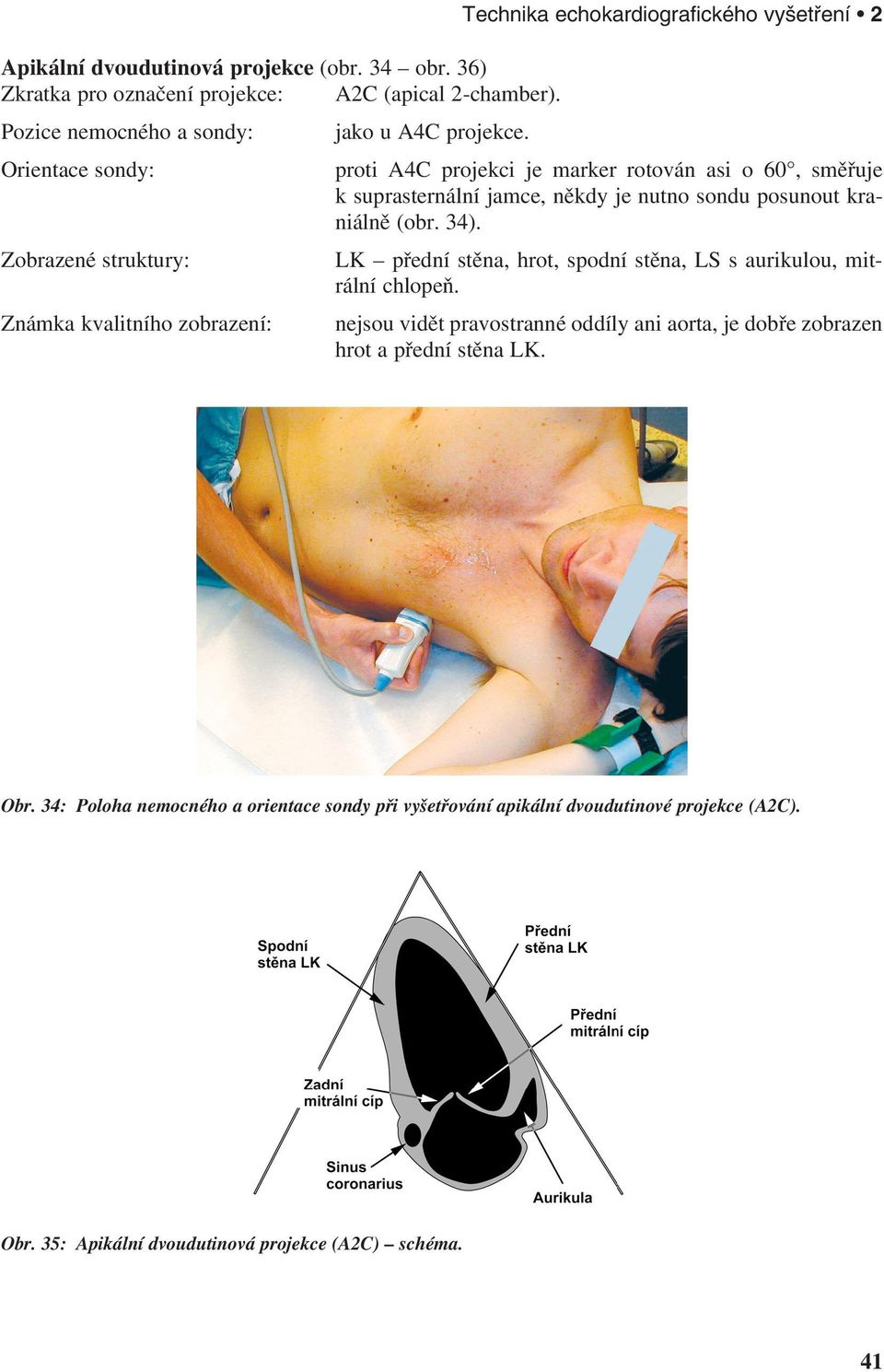Orientace sondy: proti A4C projekci je marker rotován asi o 60, směřuje k suprasternální jamce, někdy je nutno sondu posunout kraniálně (obr. 34).