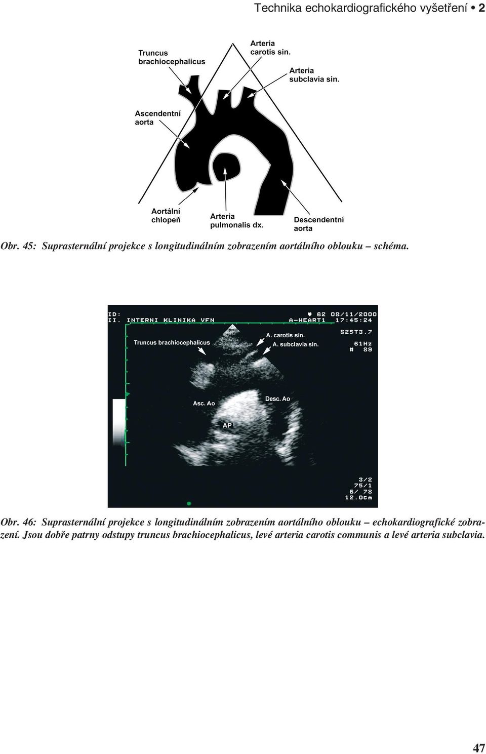 46: Suprasternální projekce s longitudinálním zobrazením aortálního oblouku