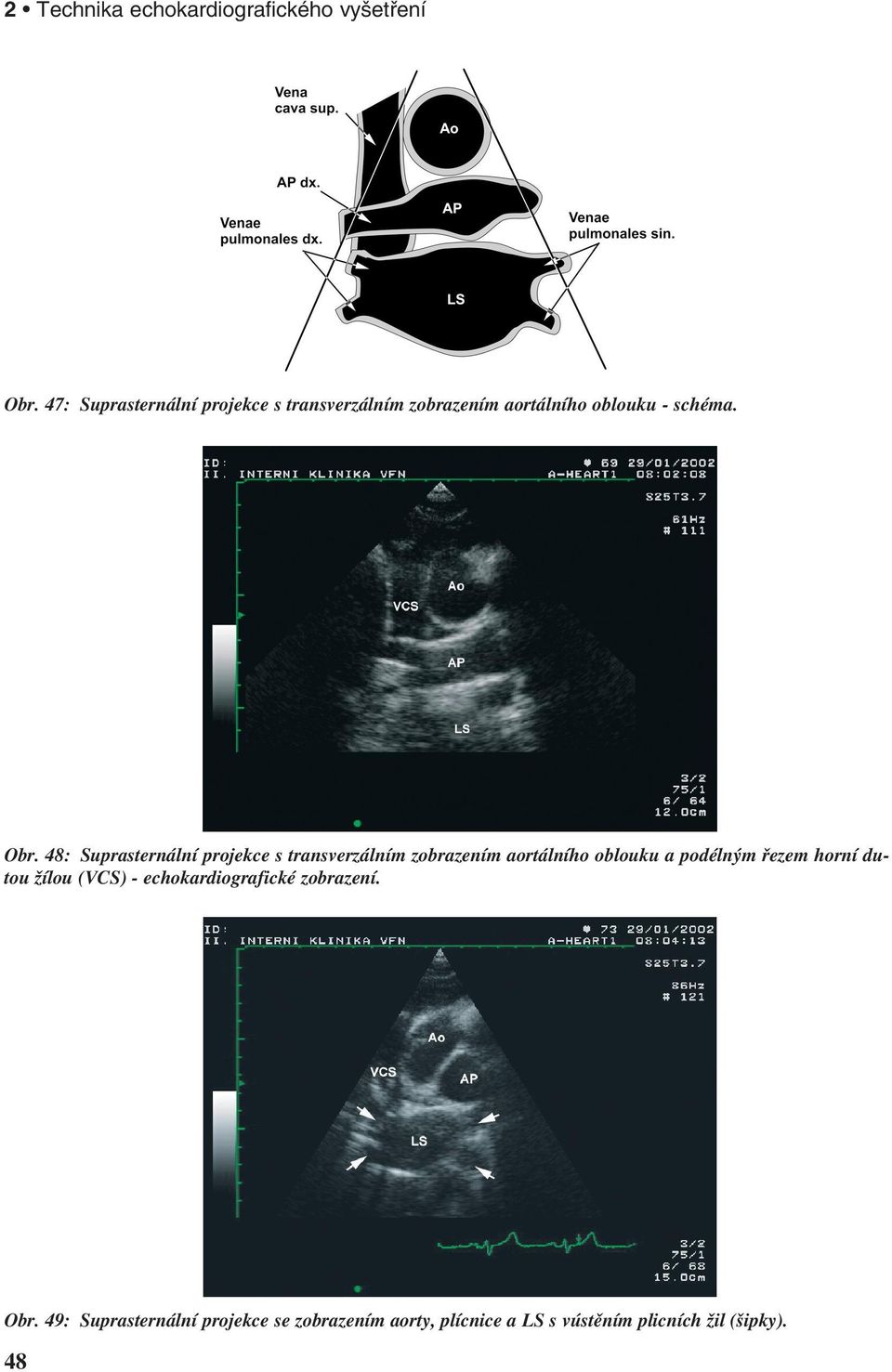 48: Suprasternální projekce s transverzálním zobrazením aortálního oblouku a podélným řezem