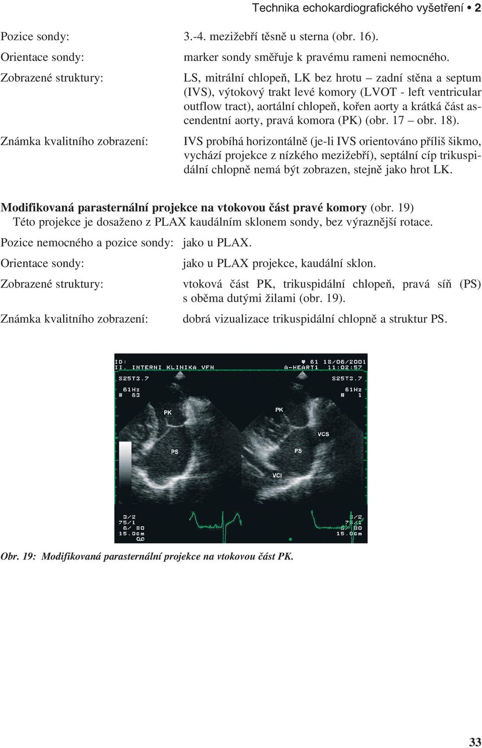 ascendentní aorty, pravá komora (PK) (obr. 17 obr. 18).