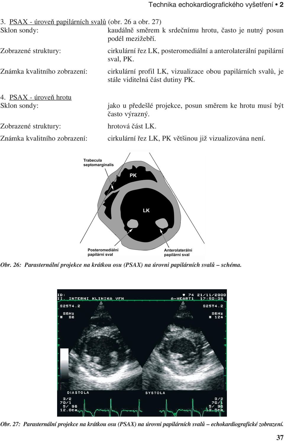 Známka kvalitního zobrazení: cirkulární profil LK, vizualizace obou papilárních svalů, je stále viditelná část dutiny PK. 4.