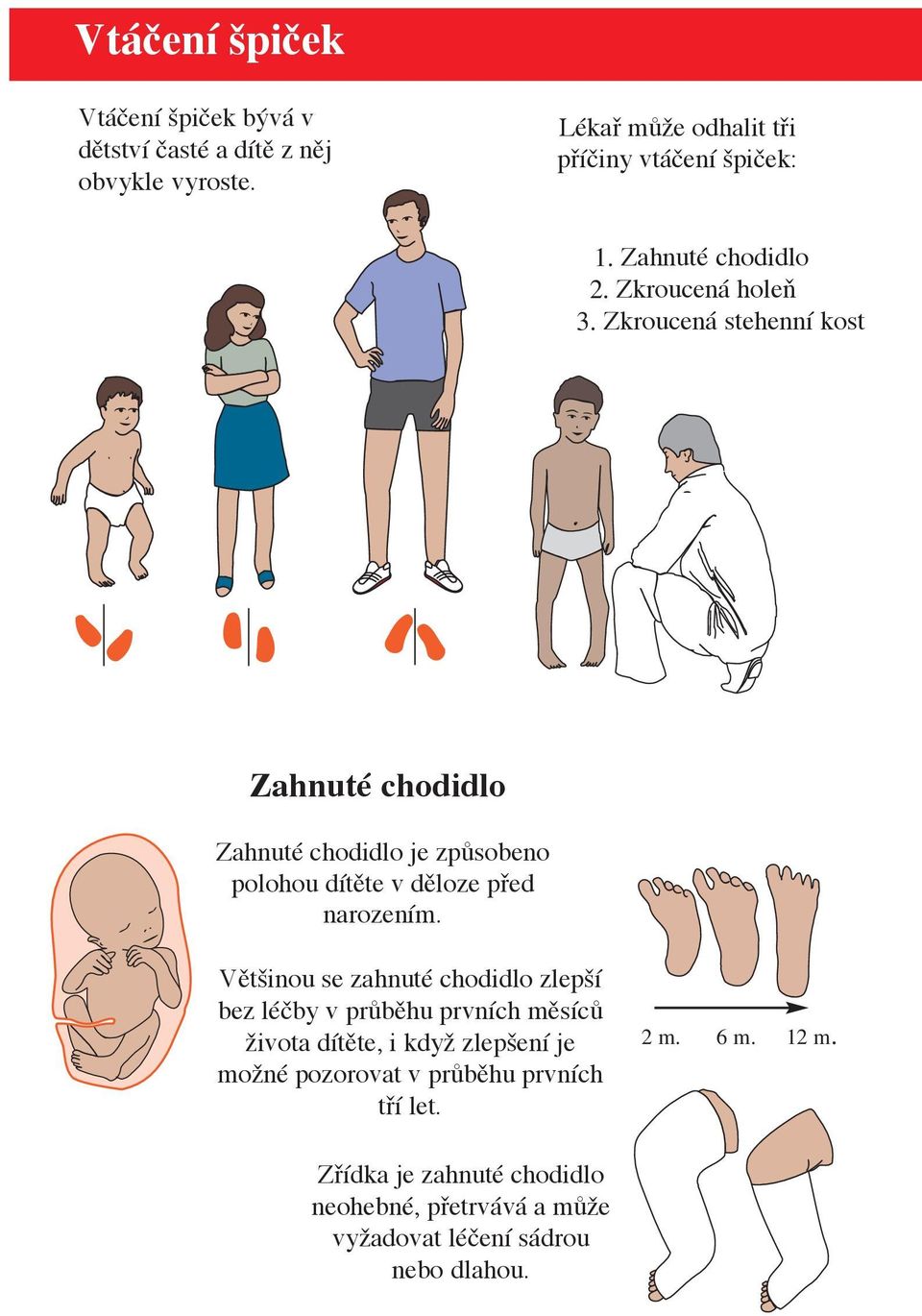 Zkroucená stehenní kost Zahnuté chodidlo Zahnuté chodidlo je způsobeno polohou dítěte v děloze před narozením.