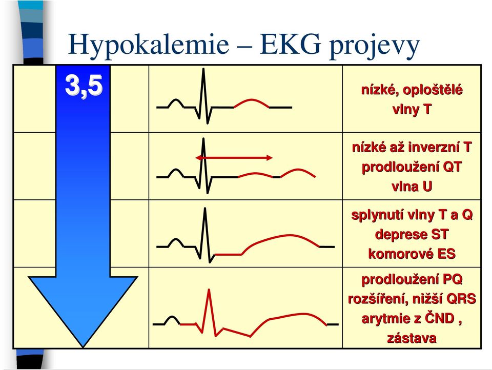 splynutí vlny T a Q deprese ST komorové ES