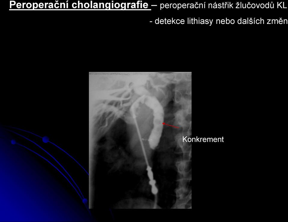 peroperační nástřik