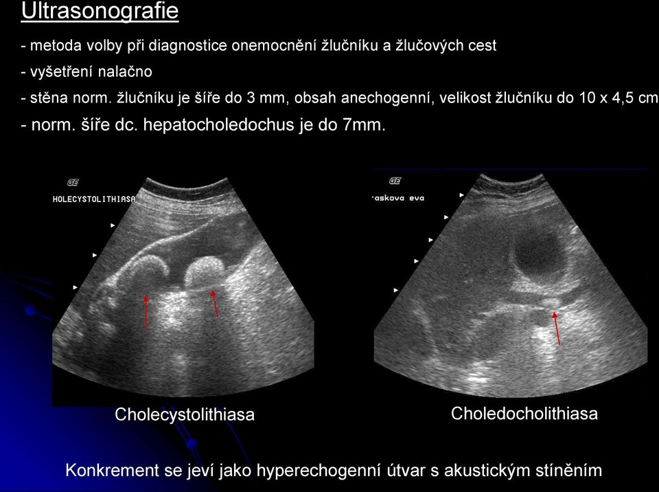 žlučníku je šíře do 3 mm, obsah anechogenní, velikost žlučníku do 10 x 4,5 cm - norm.