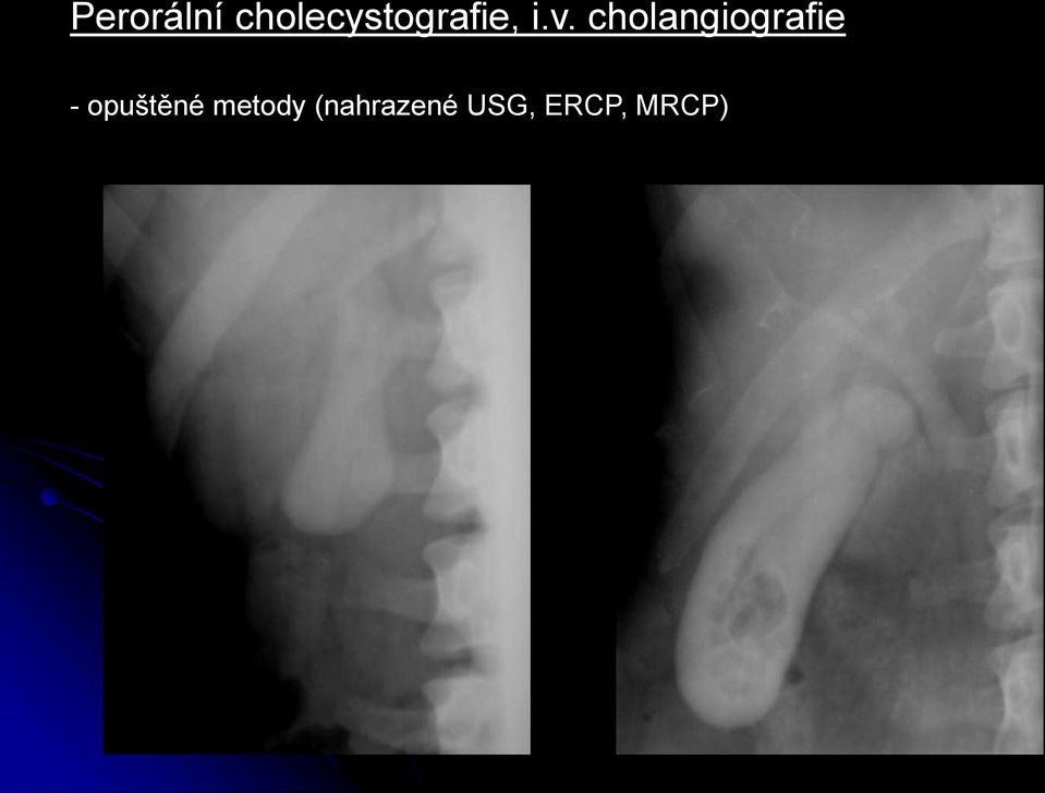 cholangiografie -