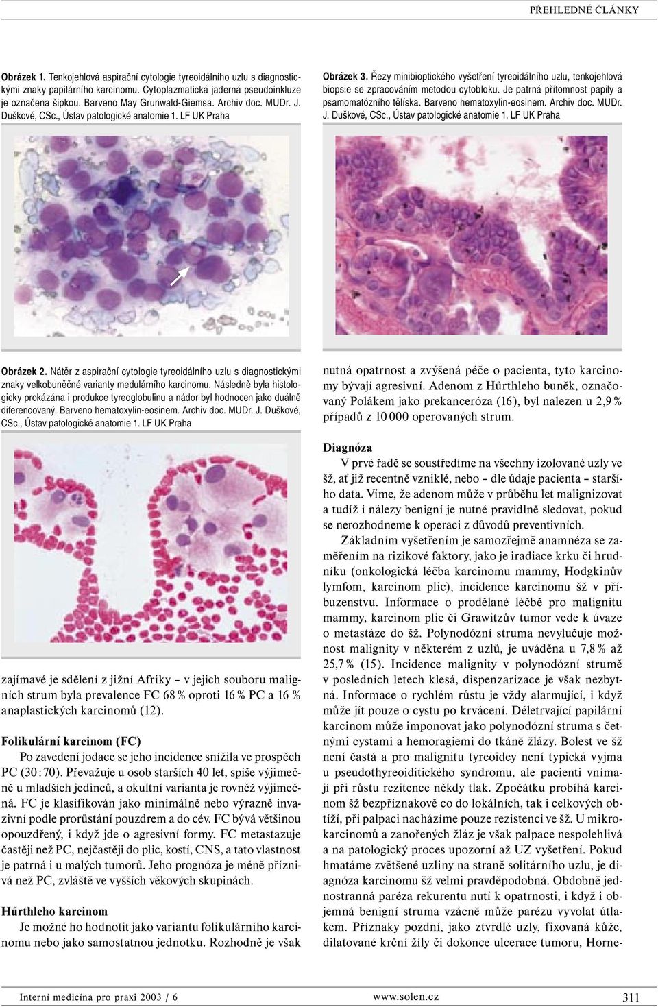 Je patrná přítomnost papily a psamomatózního tělíska. Barveno hematoxylin-eosinem. Archiv doc. MUDr. J. Duškové, CSc., Ústav patologické anatomie 1. LF UK Praha Obrázek 2.