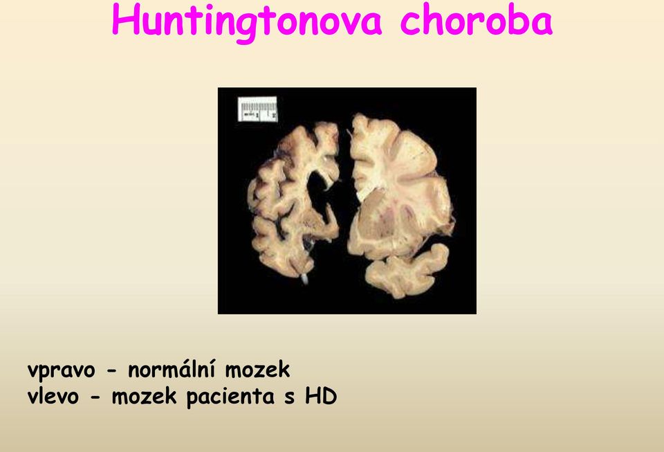 normální mozek