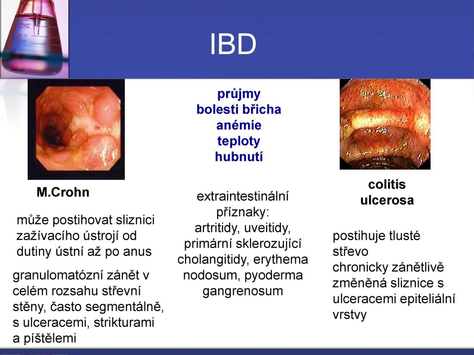 střevní stěny, často segmentálně, s ulceracemi, strikturami a píštělemi průjmy bolesti břicha anémie teploty hubnutí