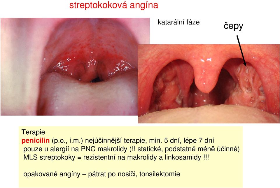 5 dní, lépe 7 dní pouze u alergií na PNC makrolidy (!