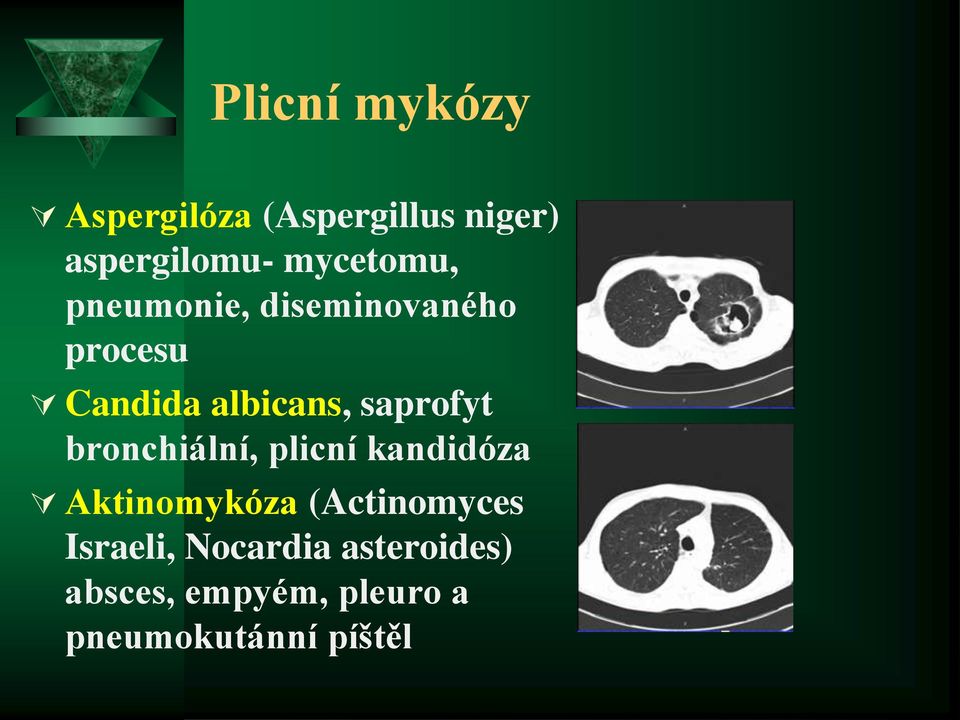 saprofyt bronchiální, plicní kandidóza Aktinomykóza (Actinomyces