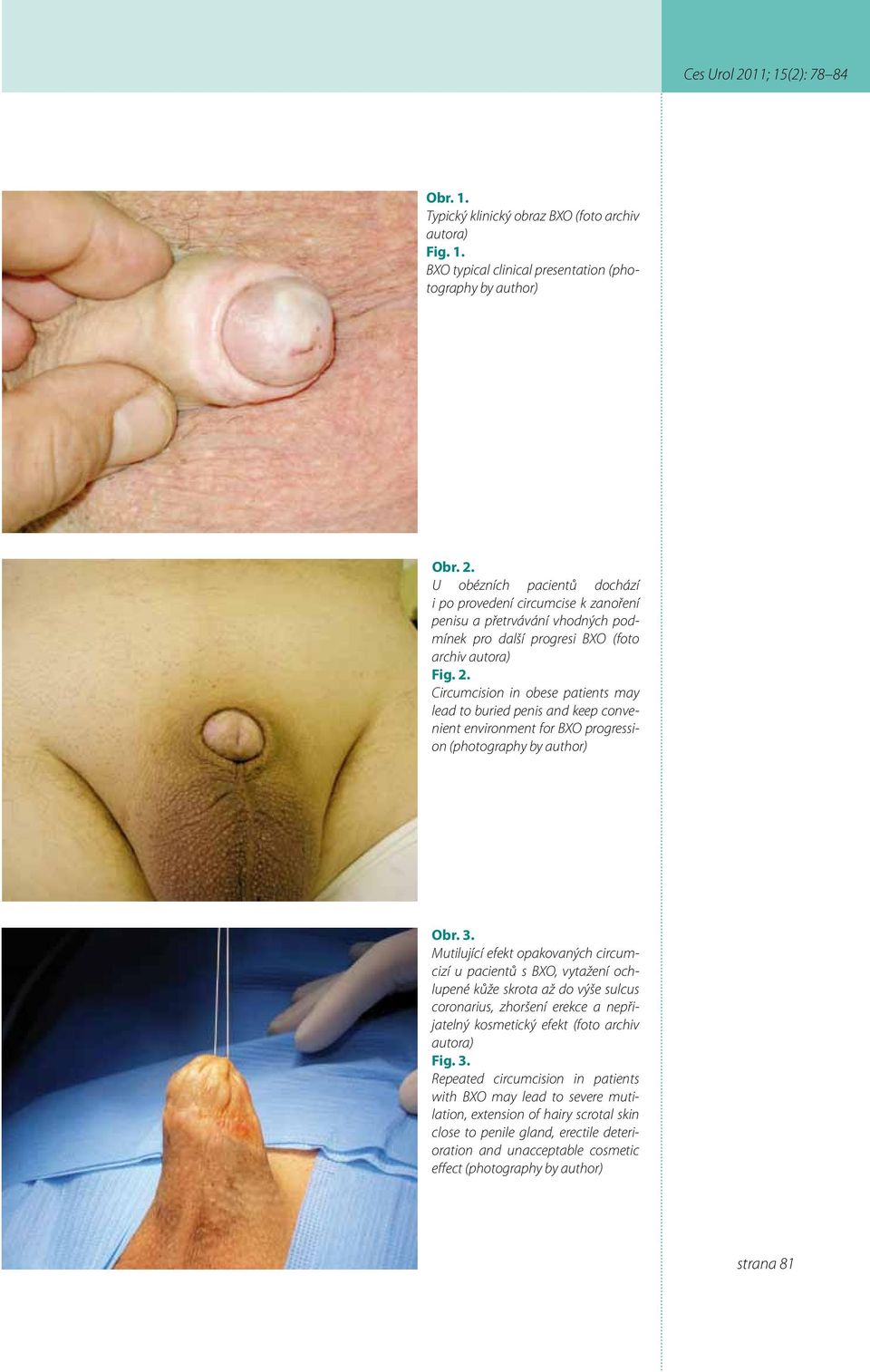 Circumcision in obese patients may lead to buried penis and keep convenient environment for BXO progression (photography by author) Obr. 3.