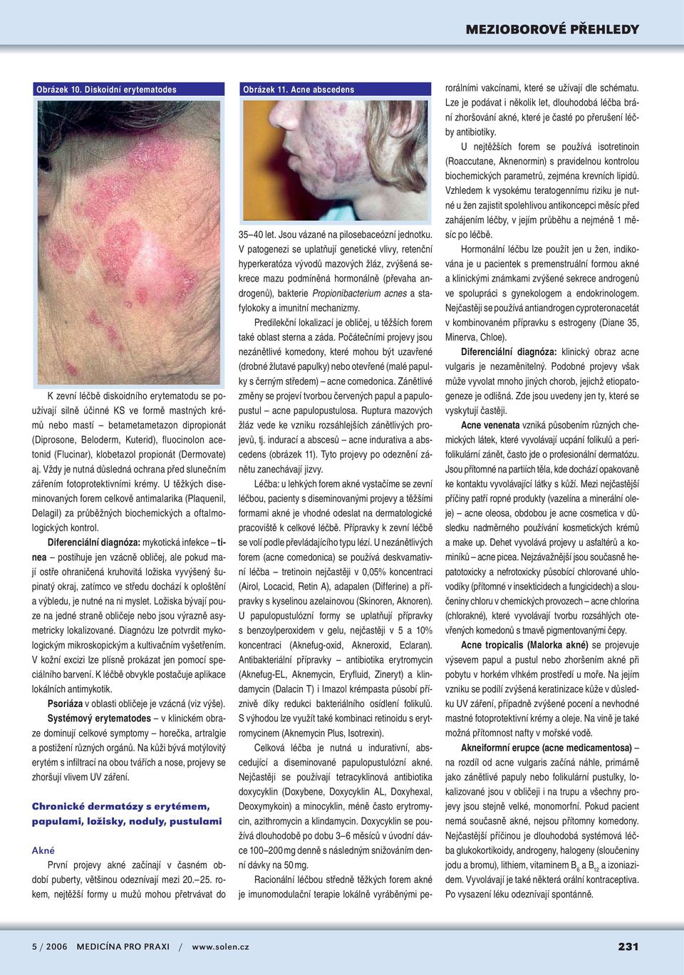 acetonid (Flucinar), klobetazol propionát (Dermovate) aj. Vždy je nutná důsledná ochrana před slunečním zářením fotoprotektivními krémy.