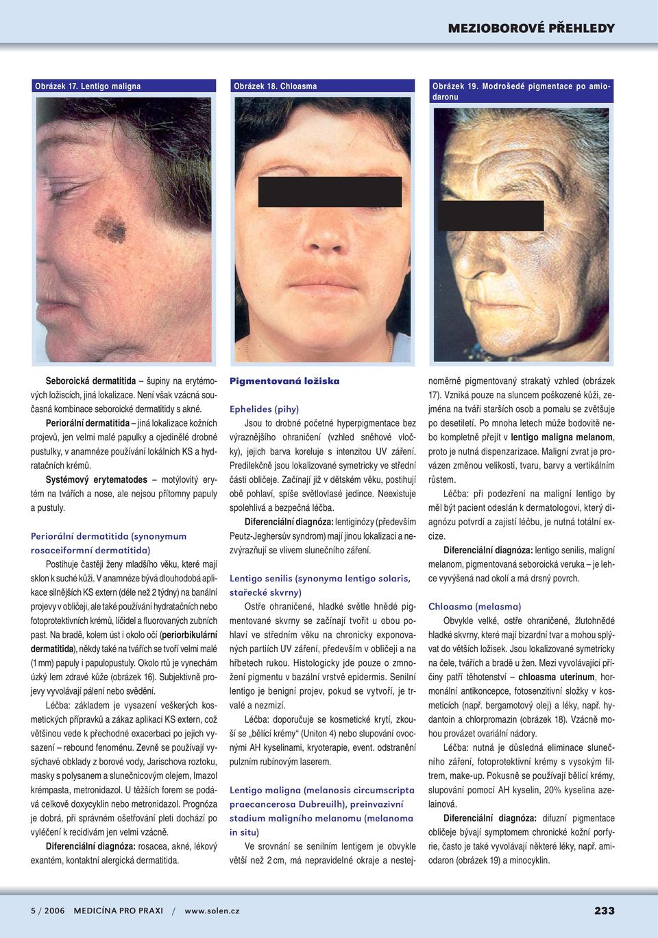 Periorální dermatitida jiná lokalizace kožních projevů, jen velmi malé papulky a ojedinělé drobné pustulky, v anamnéze používání lokálních KS a hydratačních krémů.
