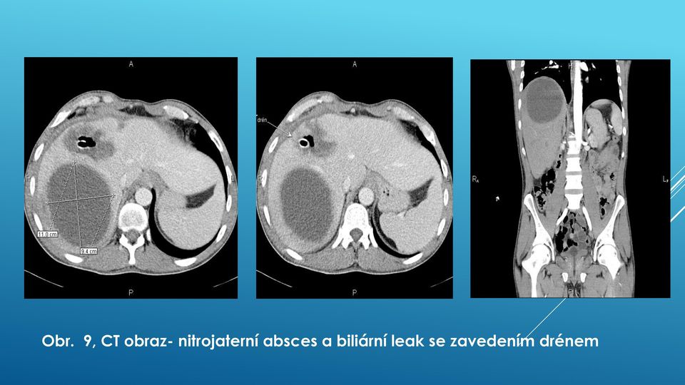 absces a biliární