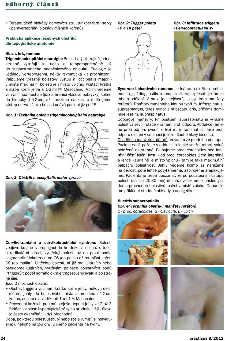 3: Infiltrace triggeru - Cervicobrachiální sy Hlava, krk, rameno Trigeminookcipitální neuralgie: Bolesti v týlní krajině jednostranně vyzařují za ucho a temporoparietálně až do stejnostranného