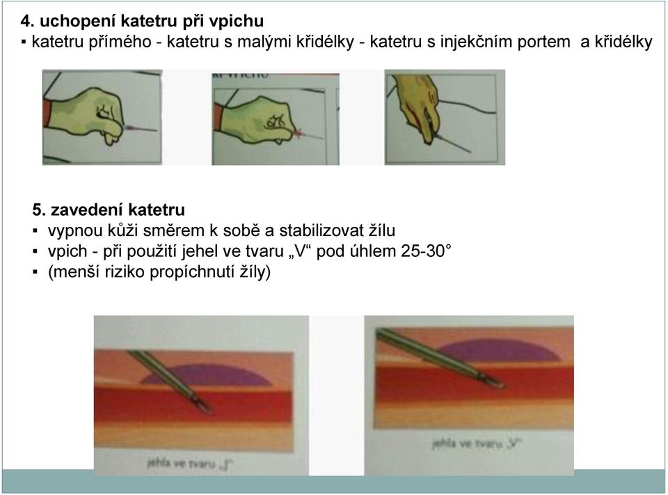 zavedení katetru vypnou kůži směrem k sobě a stabilizovat žílu