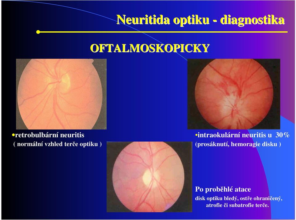 neuritis u 30% (prosáknutí, hemoragie disku ) Po proběhlé