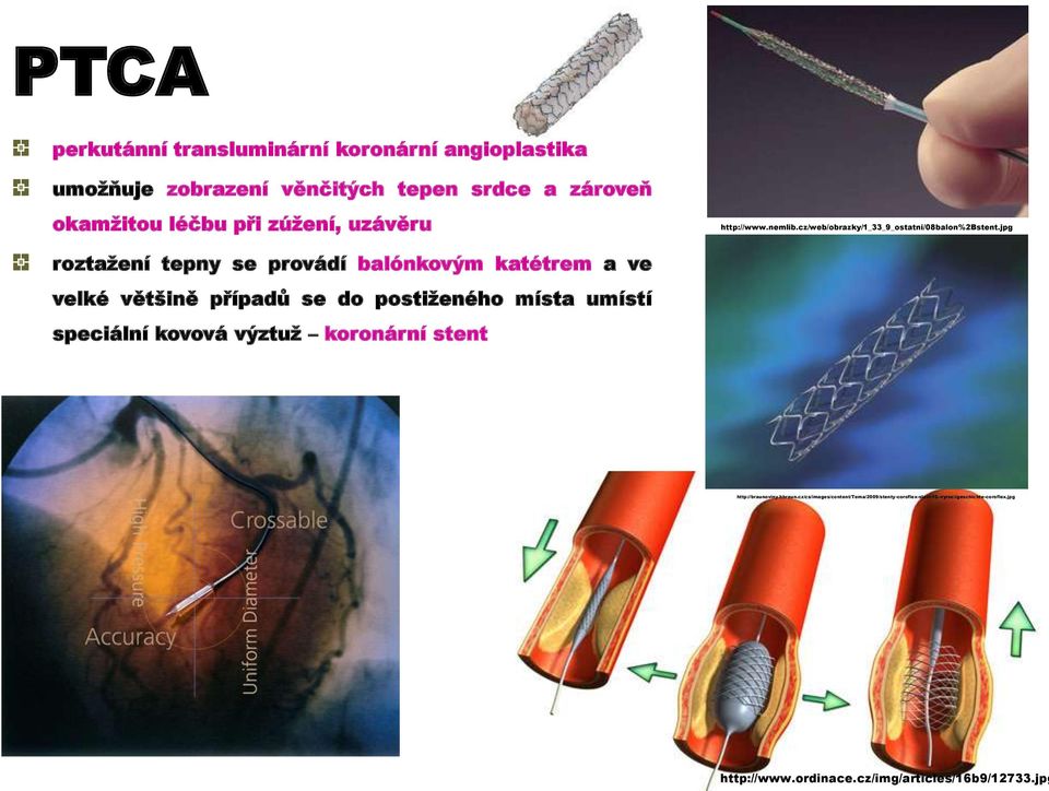 jpg roztažení tepny se provádí balónkovým katétrem a ve velké většině případů se do postiženého místa umístí speciální kovová