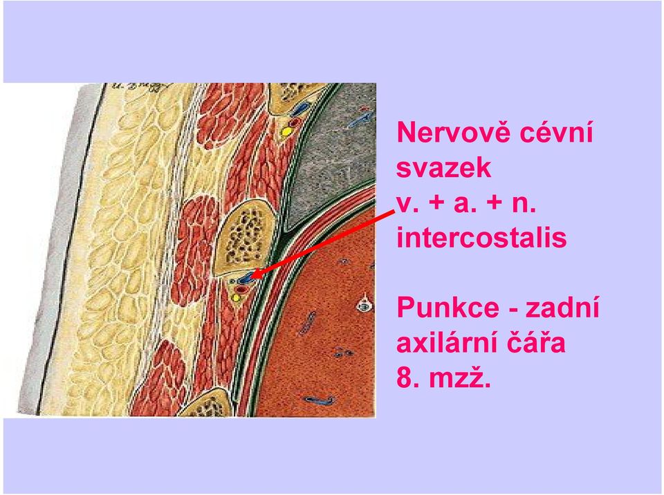 intercostalis Punkce