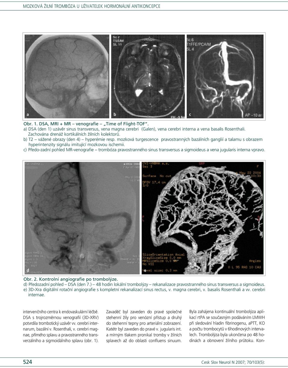 mozková turgescence pravostranných bazálních ganglií a talamu s obrazem hyperintenzity signálu imitující mozkovou ischemii.