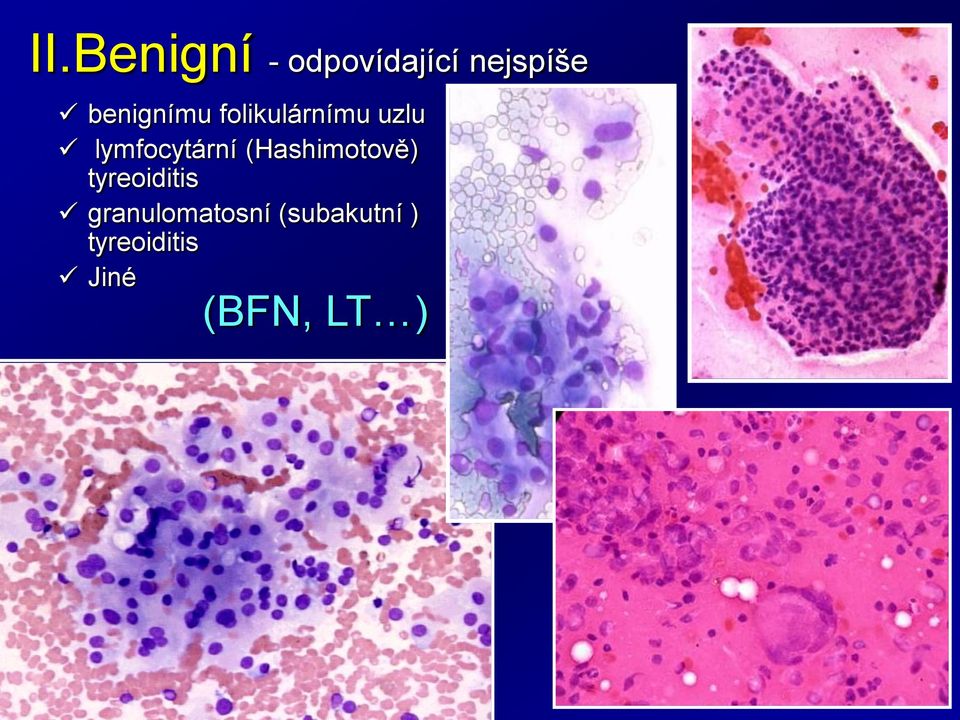 (Hashimotově) tyreoiditis granulomatosní