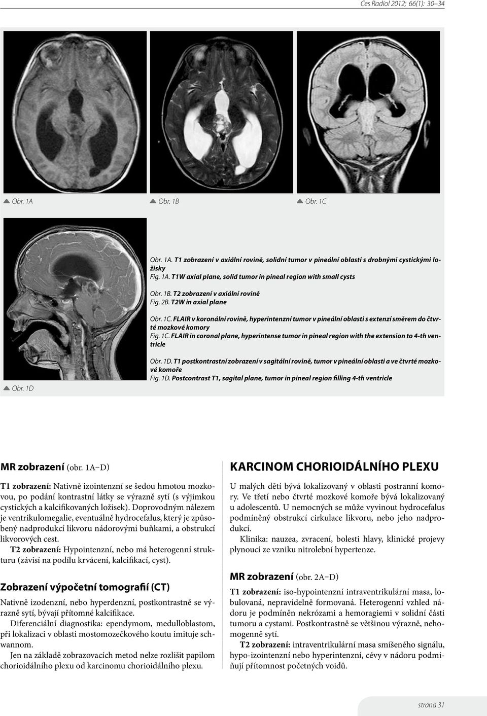 1D Obr. 1D. T1 postkontrastní zobrazení v sagitální rovině, tumor v pineální oblasti a ve čtvrté mozkové komoře Fig. 1D. Postcontrast T1, sagital plane, tumor in pineal region filling 4-th ventricle MR zobrazení (obr.
